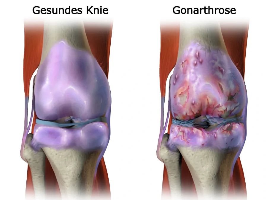 Schematische Darstellung von Gonarthrose und gesundem Knie – Vergleich