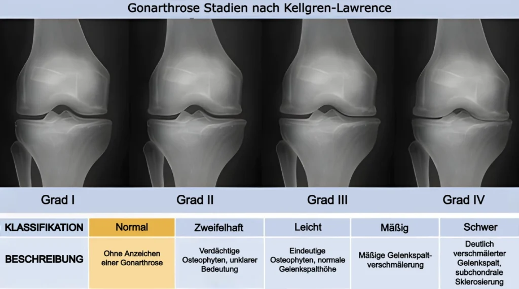 Stadien der Gonarthrose nach Kellgren-Lawrence Klassifikation
