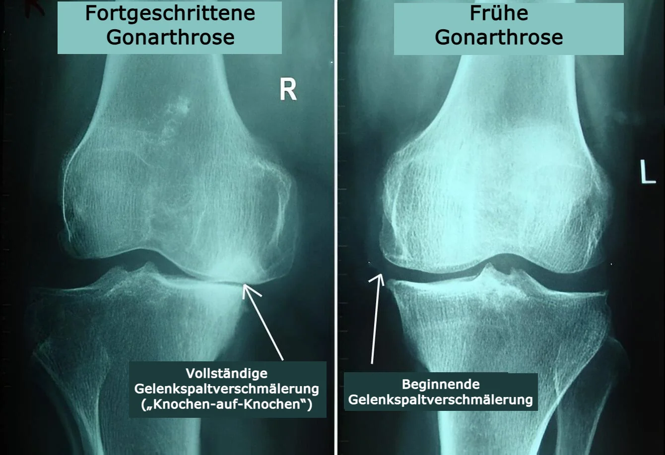 Röntgenaufnahme des Knies, die Gonarthrose Grad 4 mit beginnender Kniearthrose vergleicht