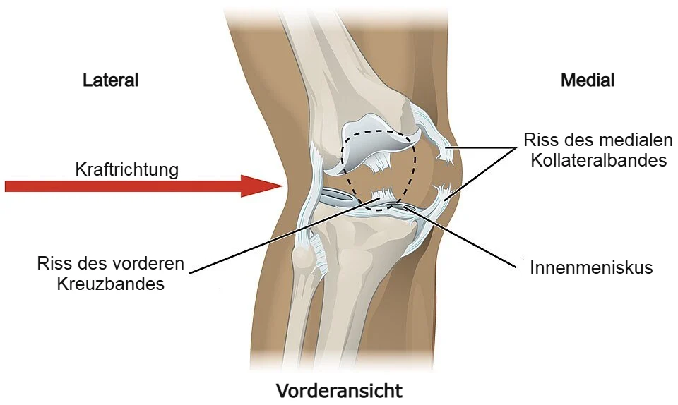 Schlag gegen die laterale Seite des Knies, der eine Valgusdeformität und einen Riss des medialen Kollateralbandes (MCL) verursacht.