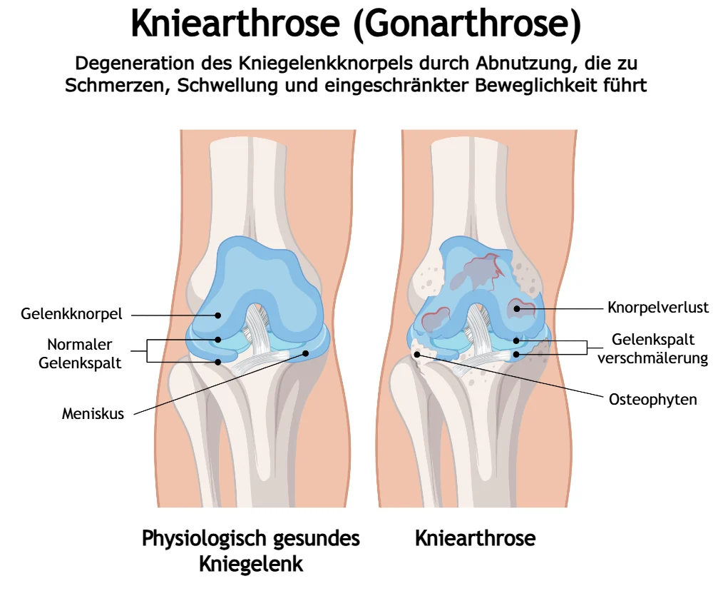 Gesundes Knie im Vergleich zu einem Knie mit Arthrose, das Knorpelschäden, eine Gelenkspaltverschmälerung und die Bildung von Osteophyten zeigt