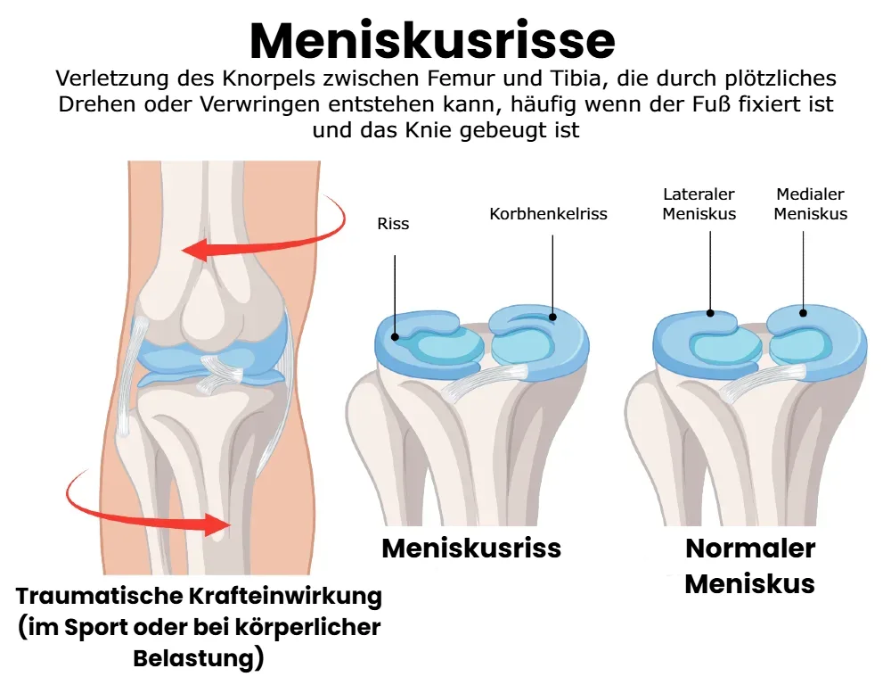 Darstellung eines Meniskusrisses im Knie, der Riss im medialen oder lateralen Meniskus zeigt.